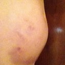 After procedure, day 2, side view bruising, still swollen.