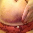After procedure, day 2, trying to show the amount of skin (and fat) actually inserted in the suction device: A whole lot, maybe that's why it's so black n blue? Even my pubic area is noticeably swollen. And my bellybutton as well.