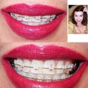 This is my 16wk smile from a distance.  Would you recognize this smile?  It's my dream to complete the process & show my teeth.