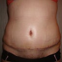 i cant believe how swollen I am since he took out the drain (yesterday)this is day 8