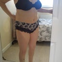 17 days post op. You can see a big difference already!!