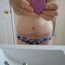 Scar looks worse here than it is. 17 days.