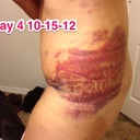Left side bruising from lipo....just to give you a good scare!!! No, really looks worse than it feels, lol!