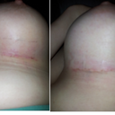 Scar under breasts 12 days