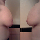 Still sitting high. Can see some breast tissue hanging below. PS is optimistic that will fill as the breasts settle, I'm trying to remain optimistic as well