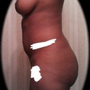 Preop - I'm slightly holding my stomach in on this one (sorry) but as you can see, I need more projection.