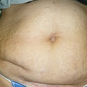 Before Picture.  As difficult as it is to post a picture of my stomach it's something I must do for all to understand why I went through with the Tummy Tuck surgery.  I have scars from having had two c-section and my appendix removed.  I also have strecth marks gallore, after having twins at a very young age.