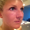 12 hours post treatment.