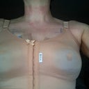 Not allowed to take MaCom bra or dressings off yet