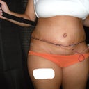 4 days after TT w/ drain (scary I know)