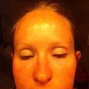 24 hours after injections...reduced swelling