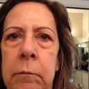 Before..note even the lower eyes are improved in after shot and procedure was only upper and mini.