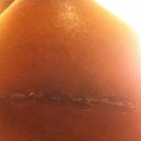 Incision. Still healing.