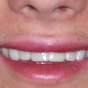 after..no make-up..new teeth (well not the permanent ones)