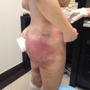One day post-op @ first consultation... looks like I have a shelf?
