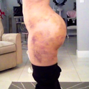 5 days post-op (super swollen w/o garment for 4 days =( Back scoop VERY swollen. Triangle was only in place w garment for 24 hrs.