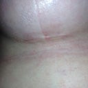 Incision that is doing really well 15 days post-op