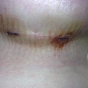 Incision that still is healing and bleeding...15 days post-op