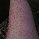 gross... My freckles were very light. But after this first IPL they all came out dark & raised up.. started peeling off brown spots.