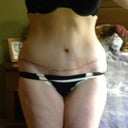 tummy tuck incision 5 weeks post op