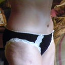 Tummy Tuck 10 weeks post op