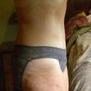 6 months post OP