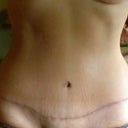 6 months post OP