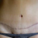 6 months post OP