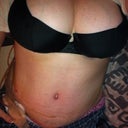 Well here I am 7 days post op