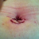 Day 3, post op