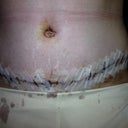 Day 4, post op