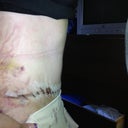 Day 4, post op