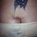 Day 4, post op