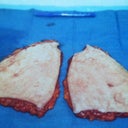 Look at all that skin!  Doc took 1.5 pounds of skin/fatty tissue, and lipo'd 300 cc's or about 1 pounds of fat from my hips and tummy.