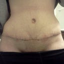 First look at scar. Swollen but happy