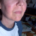Day 2 and rednesso is back, still swollen and you can see BAD vein issues that are worse than before. Hope that goes away!