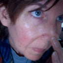 Day 5 and this area in fold of nose is oozing and red. Plus you can see red cheeks still.
