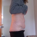 Day 12 PO, you can see the swelling above and below my BB