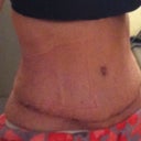 3 weeks post op