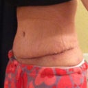 3 weeks post op