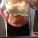 1day postop alot smaller.