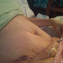 this was day 3 po, I think.  Horribly swollen and disfigured, I had a rough time this day.