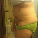 5 dpo.  Horribly swollen and feeling very upset, I mean look at how awful it looks