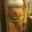 5 dpo  Not much better from the front.  I am seriously fearful I am going to end up with a lopsided tummy.