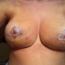 3 weeks - a bit of skin irritation from the tape