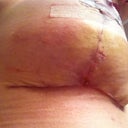 Right, 3 weeks - a bit of skin irritation from the tape
