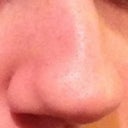 Right view at an angle before - this is the bulbous nostril that will be removed