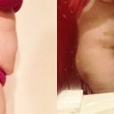 Before and After 2 days Post Op