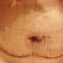 Day After Procedure