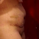 Day After Procedure